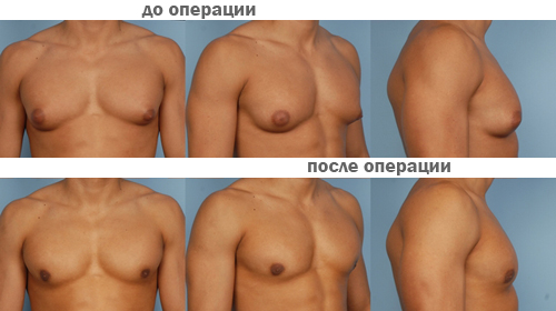 Фото увеличения груди у мужчин